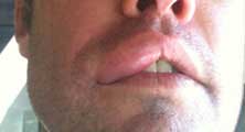 Riverside Bee Removal Guy Anthony picture of swelling after being stung 
    on the lip.